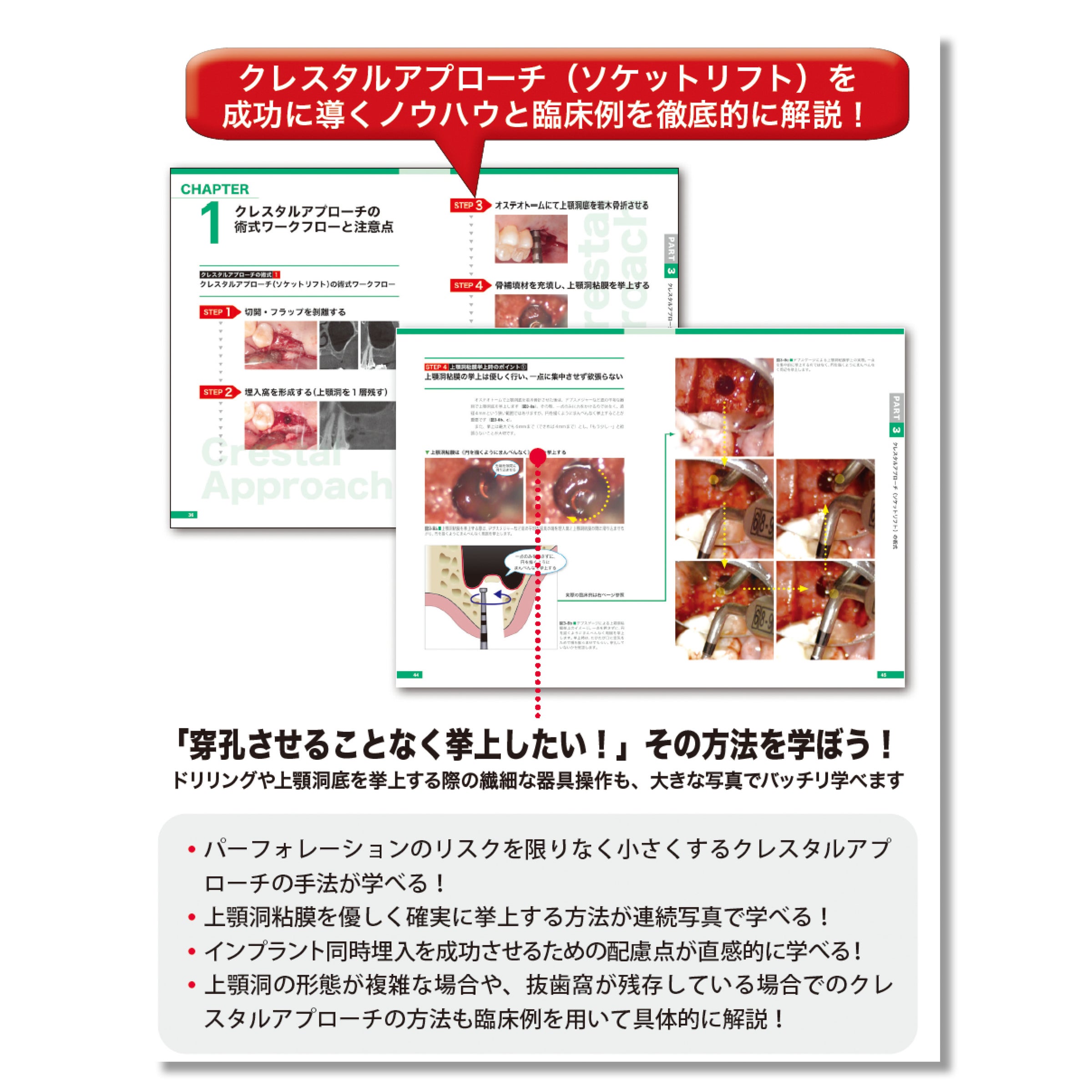 【裁断済み】インプラント補綴マニュアル 補綴術式マニュアル|株式会社インプラテックス