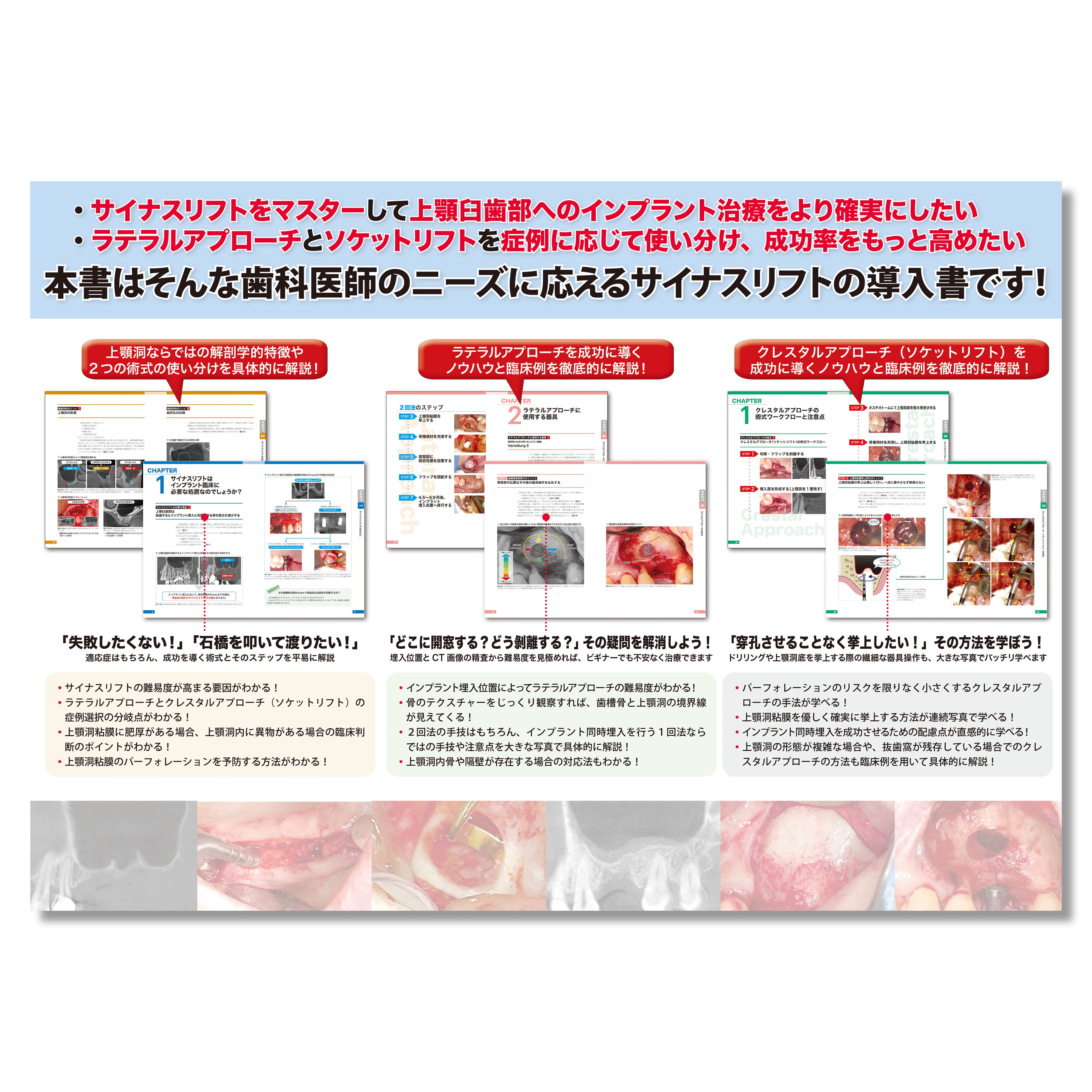 662 無理なくできるサイナスリフト導入マニュアル | Shop Co.