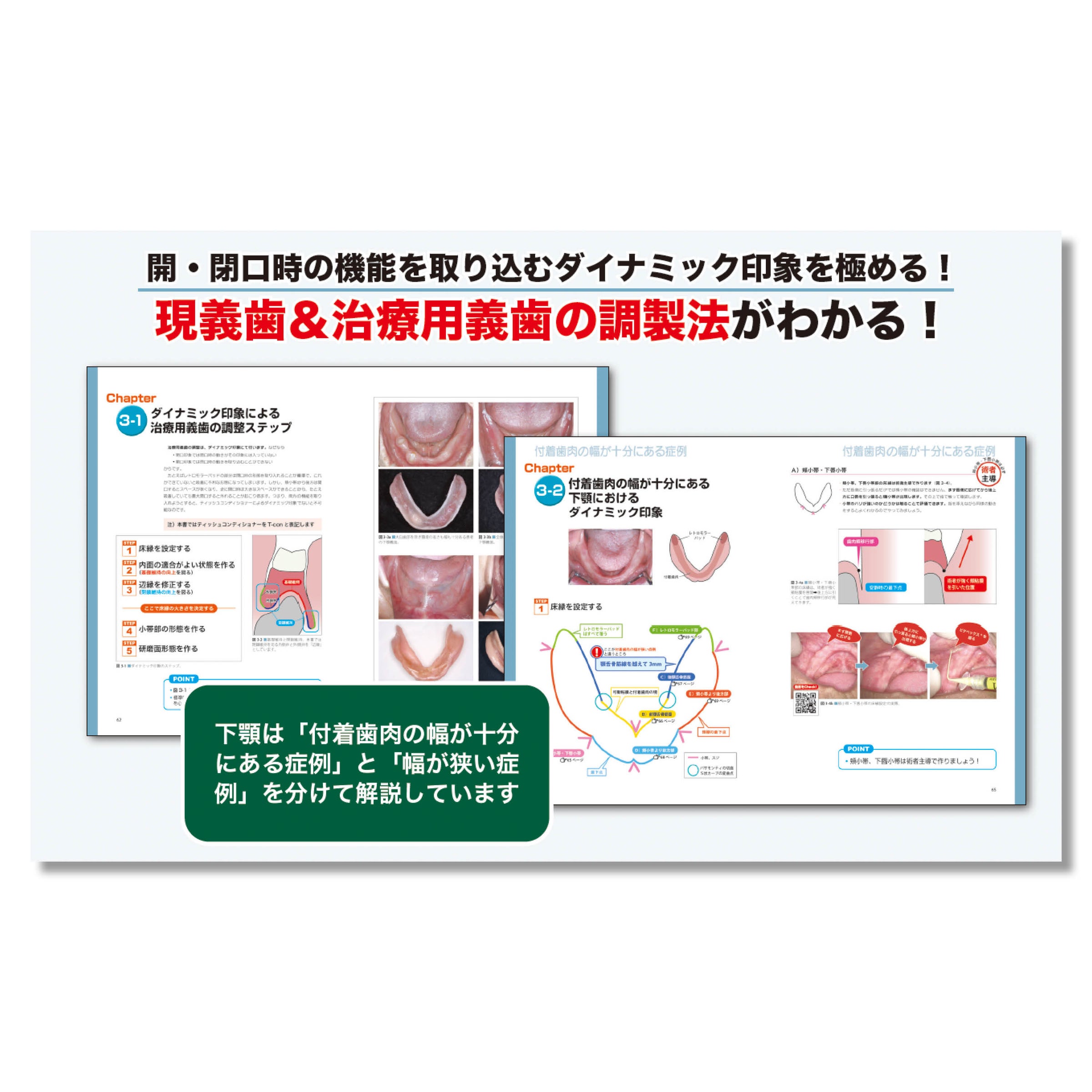 患者さんが総義歯を使いこなすためのトレーニング法と義歯調整法 675 患者さんが総義歯を使いこなすためのトレーニング法と義歯調整法