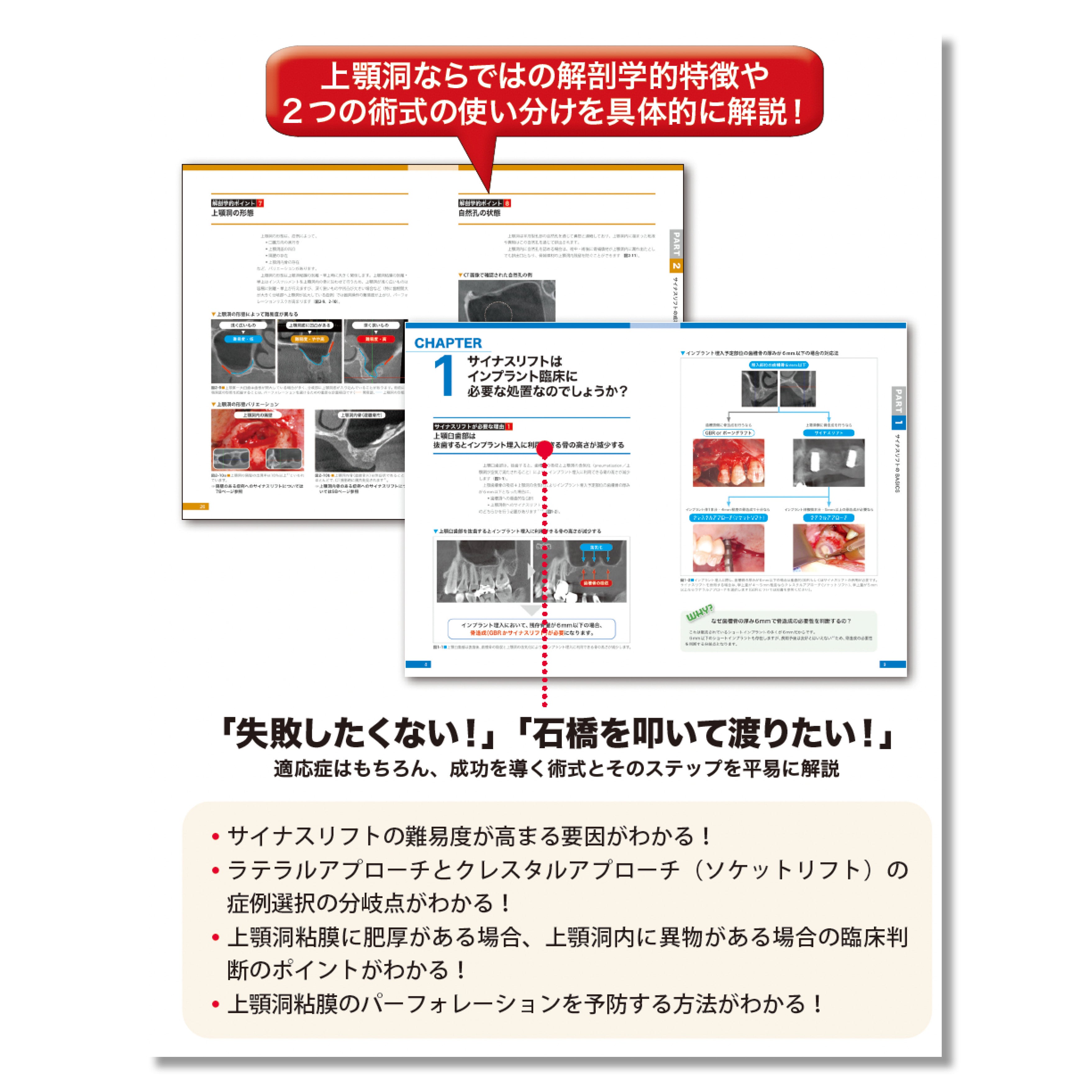 662 無理なくできるサイナスリフト導入マニュアル | Shop Co.