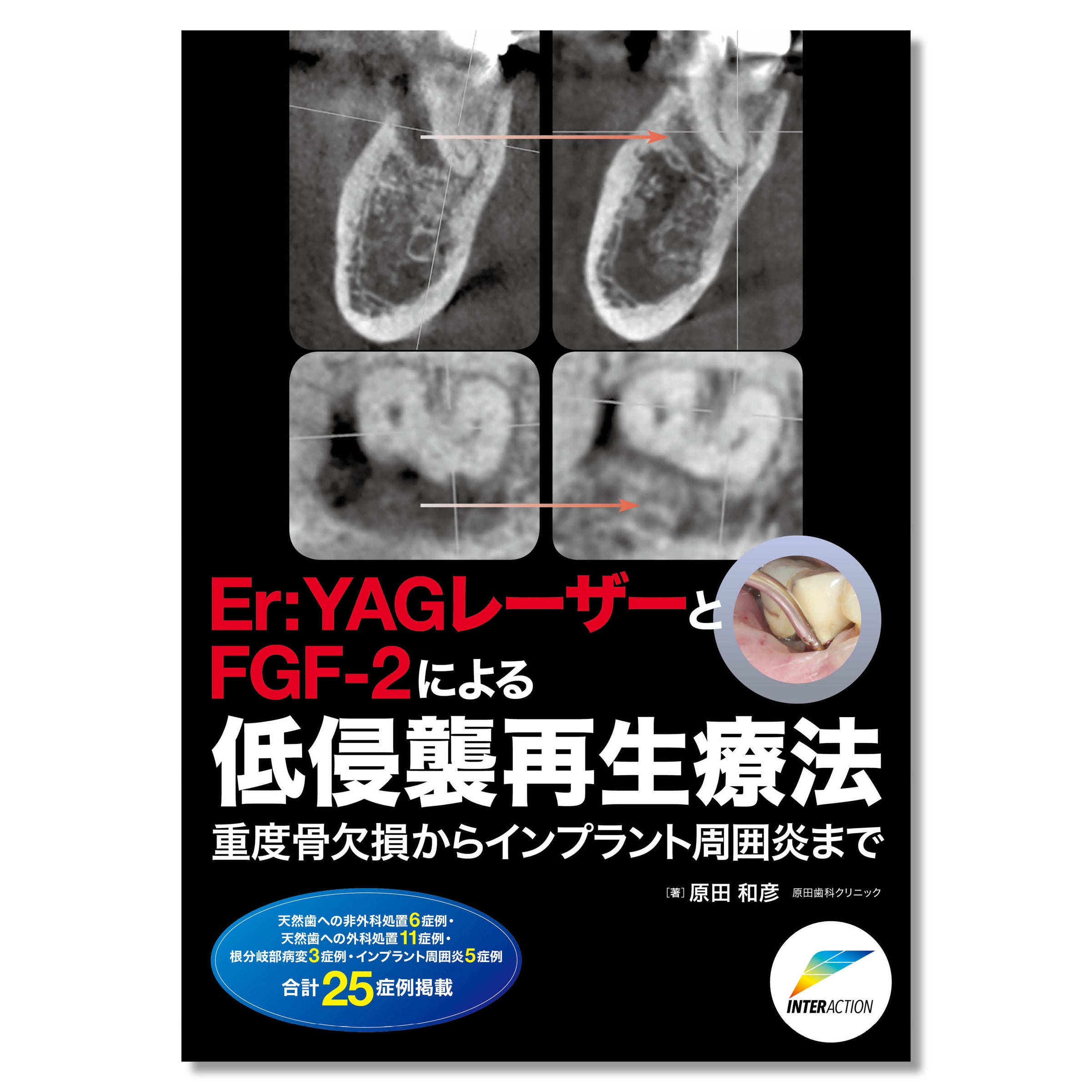 679 Er:YAGレーザーとFGF-2による低侵襲再生療法 重度骨欠損から