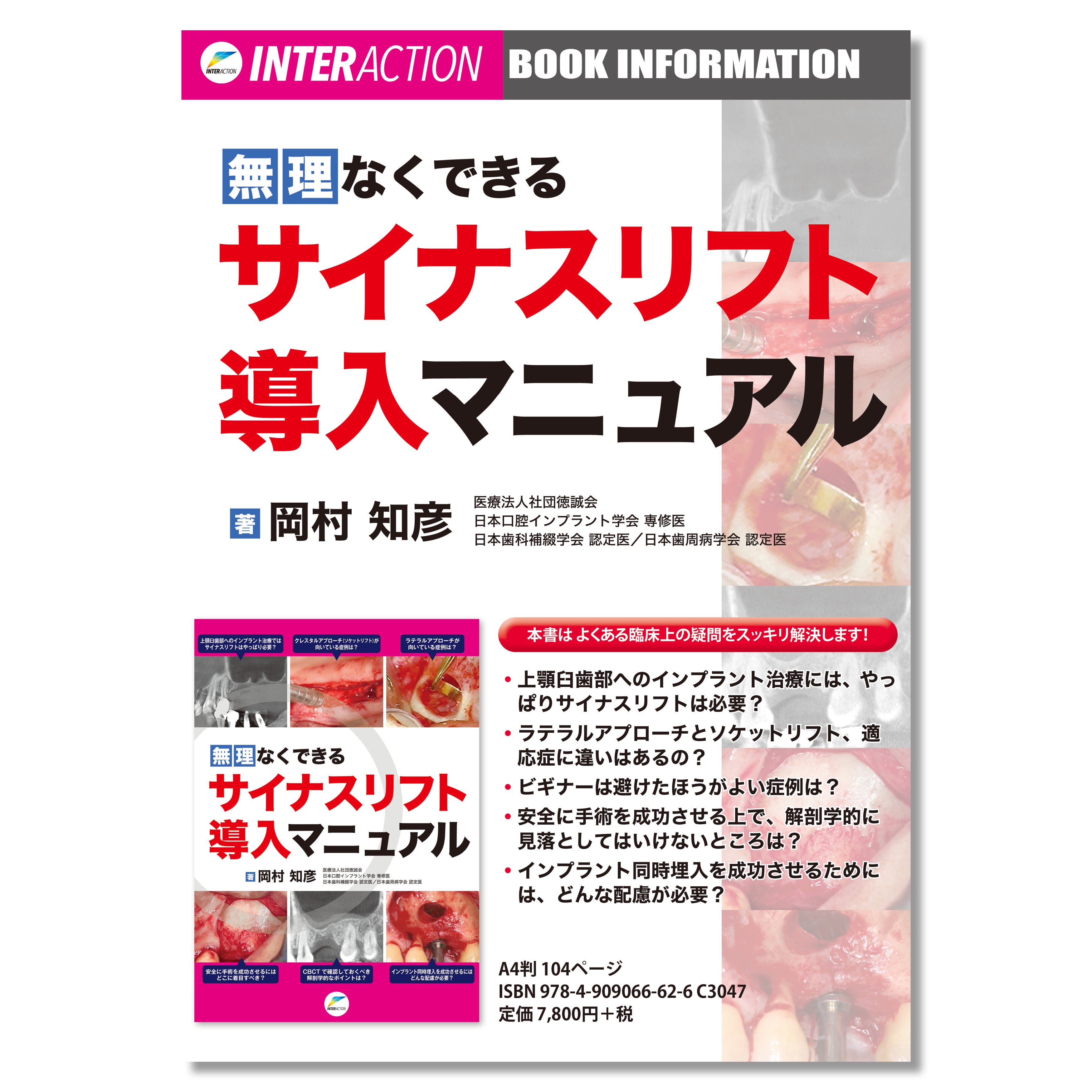 662 無理なくできるサイナスリフト導入マニュアル | Shop Co.
