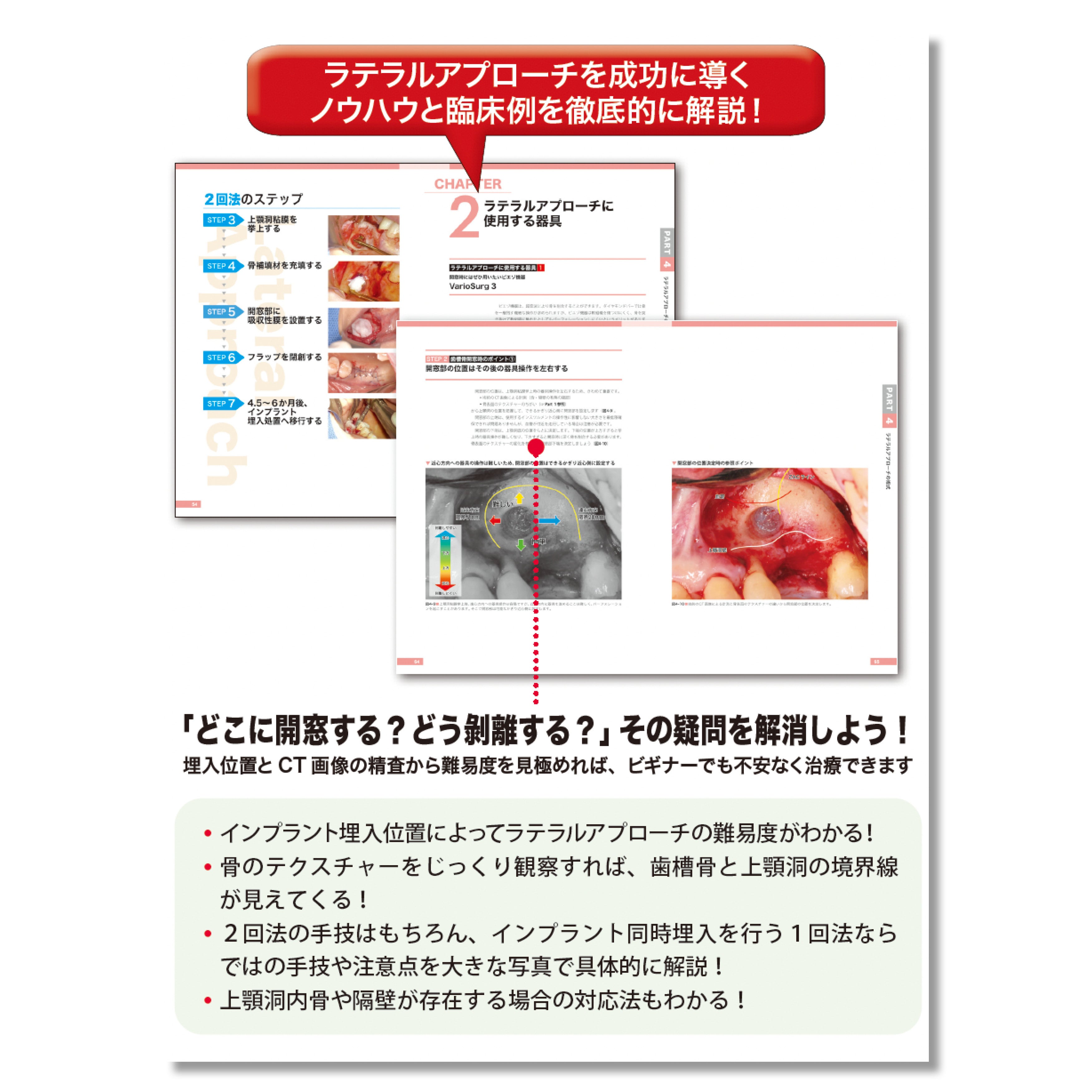 662 無理なくできるサイナスリフト導入マニュアル | Shop Co.