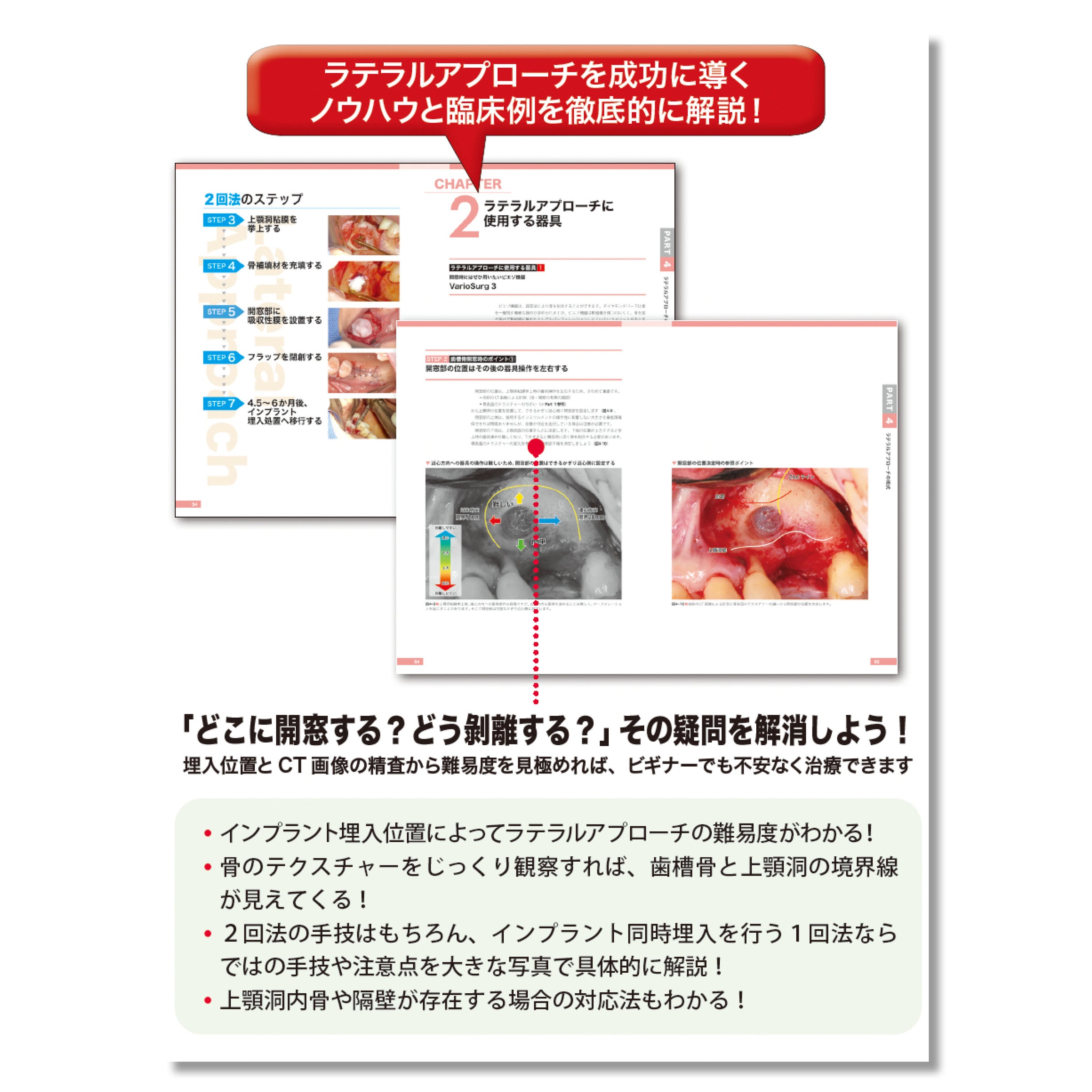 662 無理なくできるサイナスリフト導入マニュアル | Shop Co.