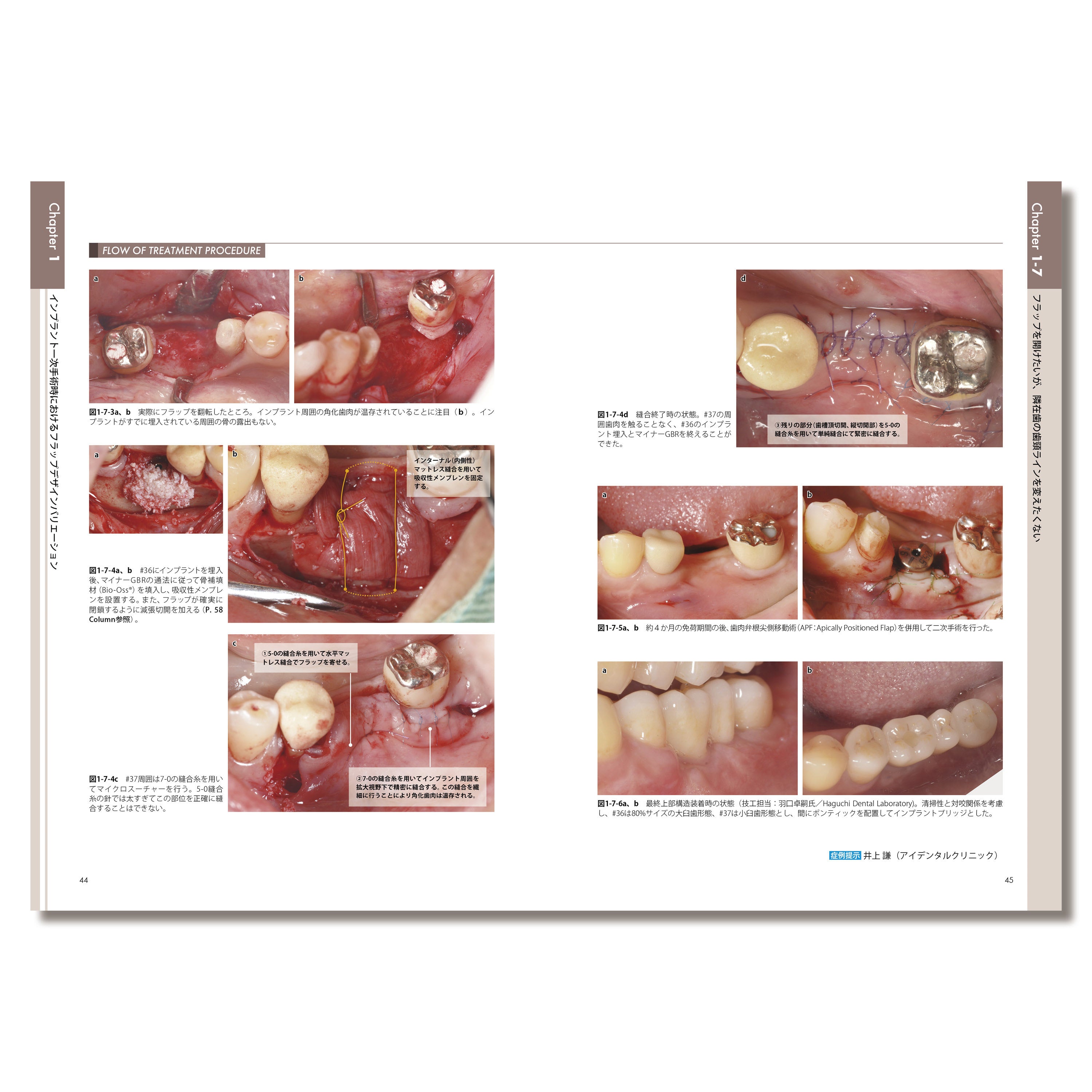 フラップデザインアルバム このシチュエーションにこの切開 このシチュエーションにこの切開 フラップデザインアルバム